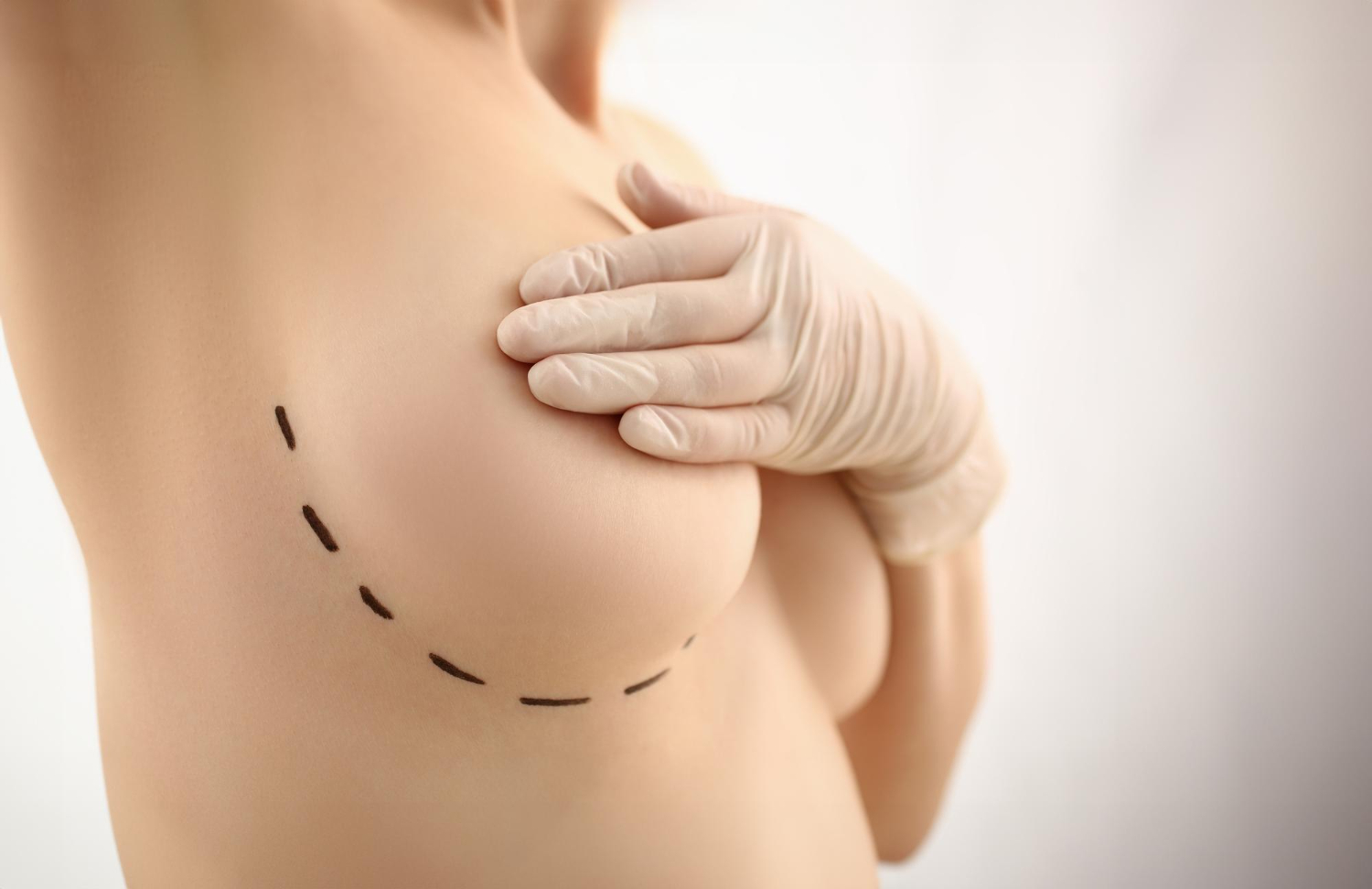 Breast Lift Surgery