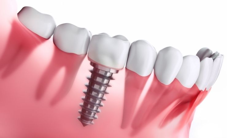 All-on-4 Dental Implants