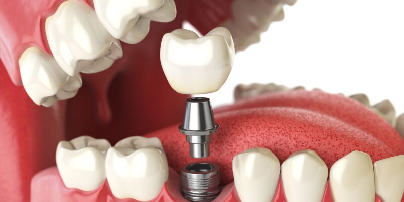 Dental Implants