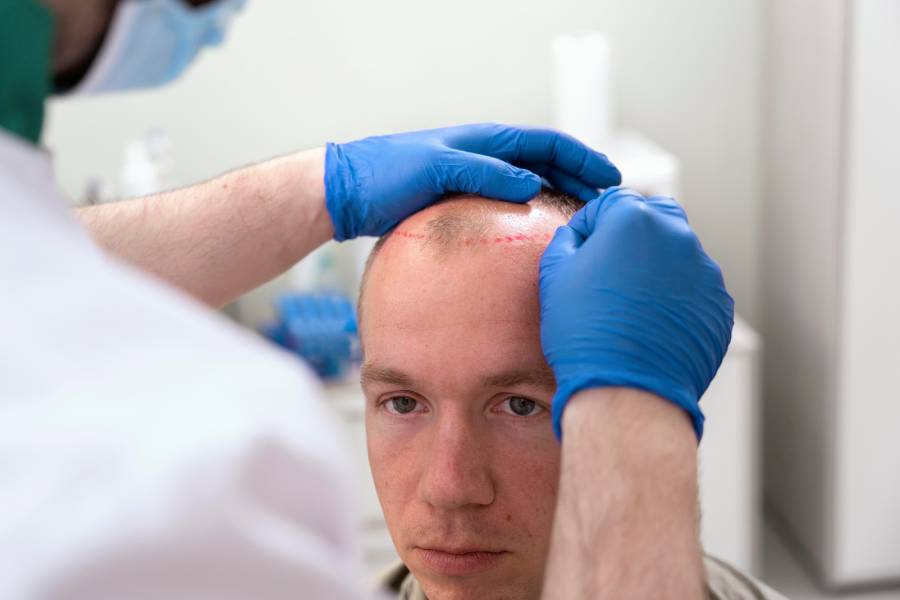 How to prevent and reduce hair transplant swelling