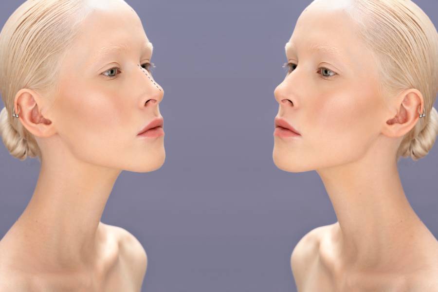 Traditional vs. Modern Nose Reshaping Techniques