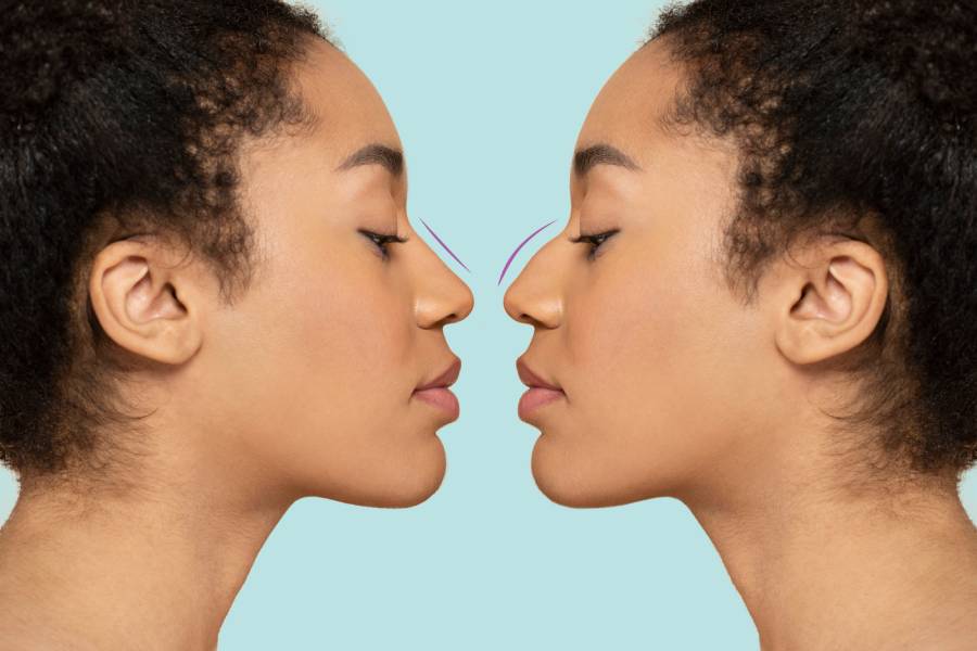 What is Ethnic Rhinoplasty?