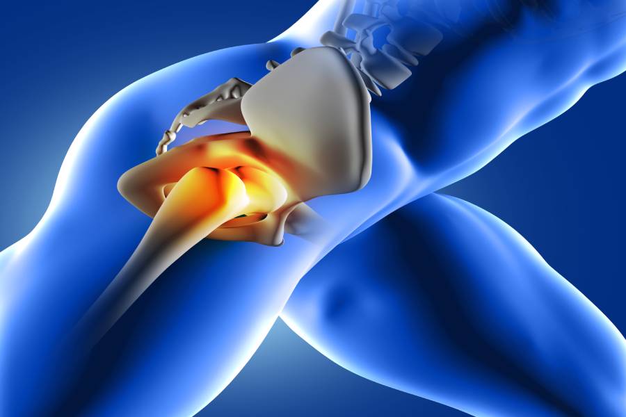 How Long Does a Hip Replacement Last?