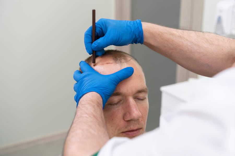When to remove scabs after hair transplant?